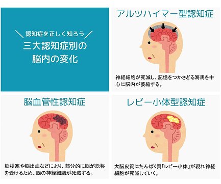 認知症は一気に進む と聞きましたが 本当なのでしょうか 介護のほんね