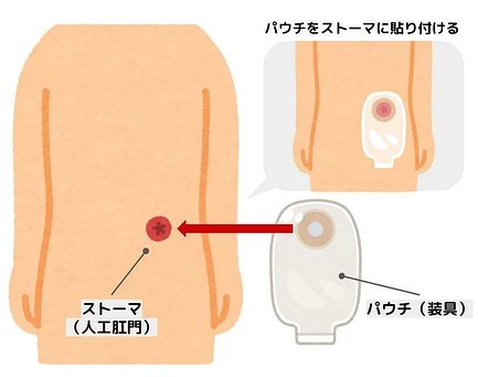 ストマとその他色々 - 看護/介護用品