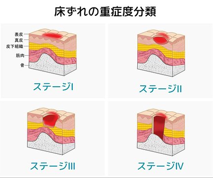 床ずれ 褥瘡 とは 防止用具での予防法や 市販薬での治療法など 介護のほんね