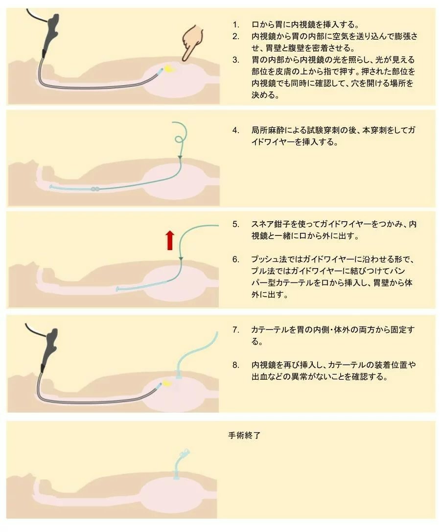 専門家監修】胃ろうとは｜メリット・デメリット・費用・種類・手術 