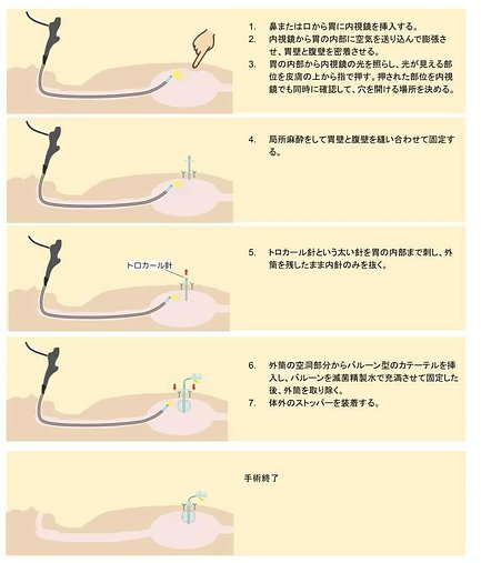 専門家監修 胃ろうとは メリット デメリット 費用 種類 手術 ケアを解説 介護のほんね